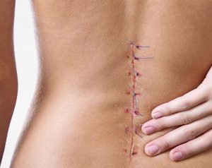 back-surgery-300x238-1
