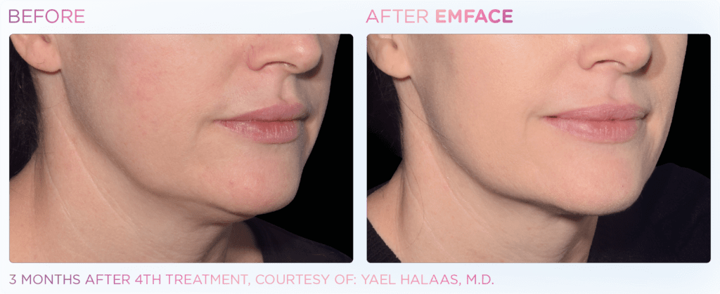 Emface_PIC_Ba-card-female-jawline-032_ENUS100-1024x419
