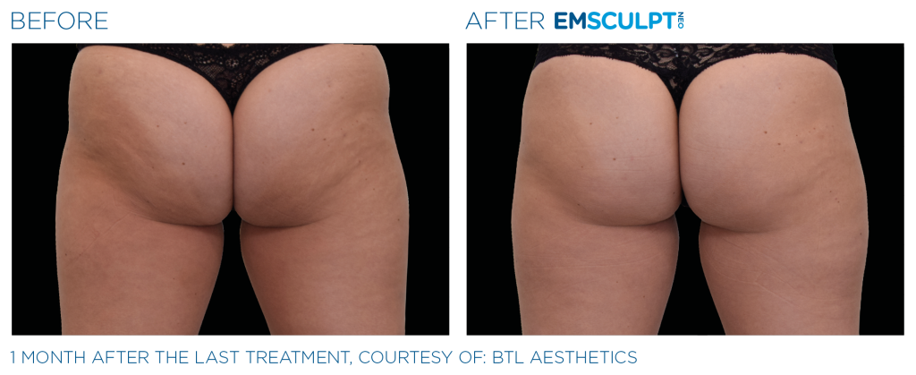 Emsculpt_neo_PIC_Ba-card-female-buttock-061_ENUS100-1024x419