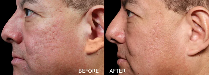 Exion-before-and-after-3-Evexia-Med-Spa-McLean-VA