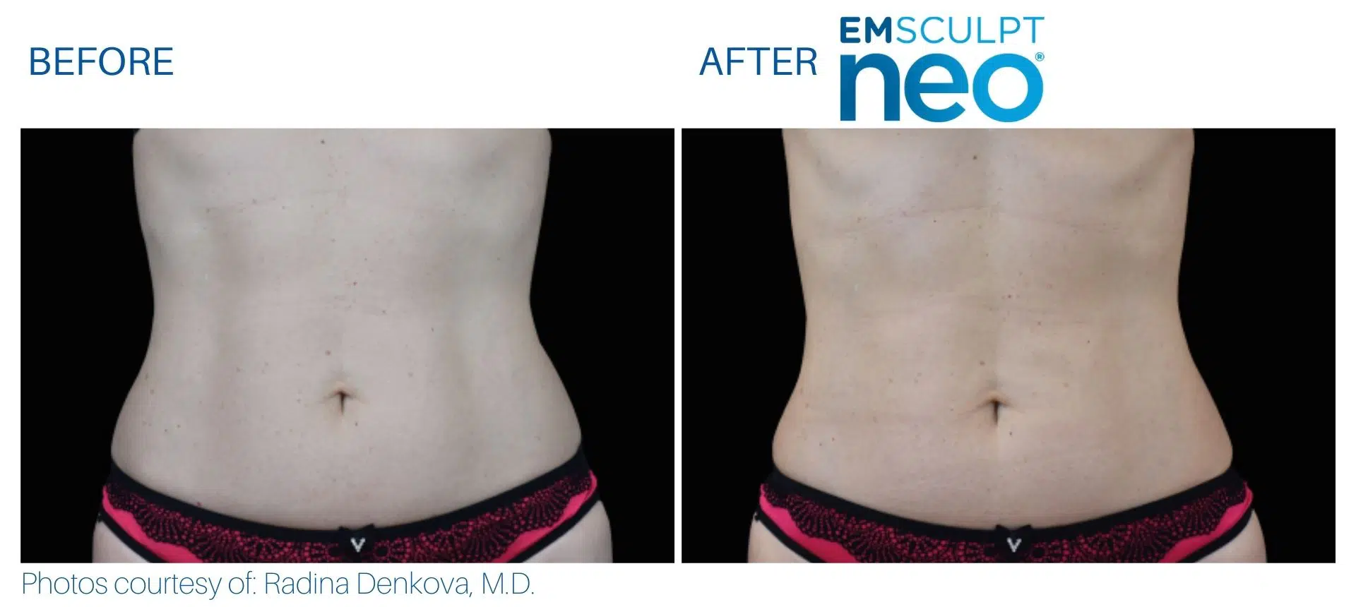 emsculpt_neo_before_and_after_pics_juliaedelmanmd_3.jpg